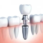 Implantes Dentales de Carga Inmediata Digital Dental Cat