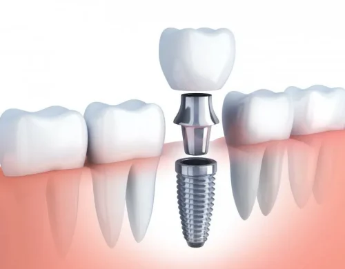 Implantes Dentales de Carga Inmediata Digital Dental Cat