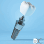 Implantes poco hueso