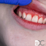 gingivitis