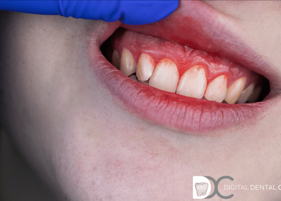 gingivitis