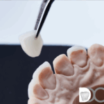 Carillas dentales en Polinyà - Digital Dental Cat