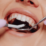 espacios interdentales
