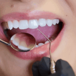 Contorneado dental