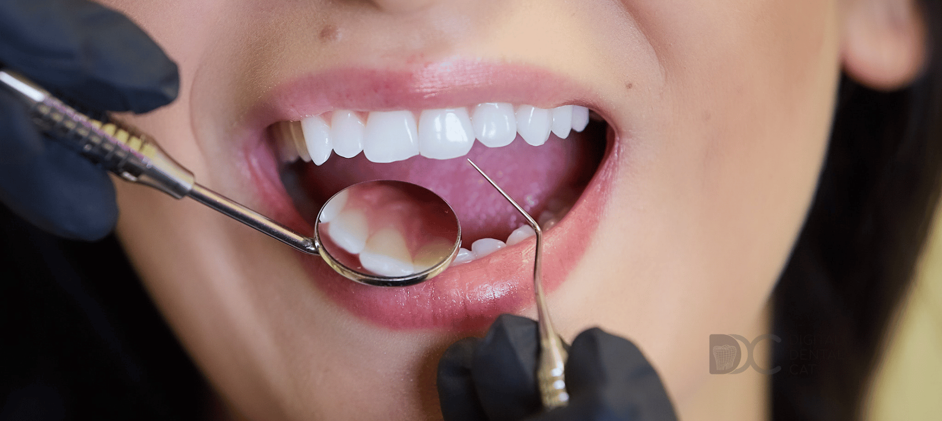 Contorneado dental