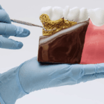 periodontitis