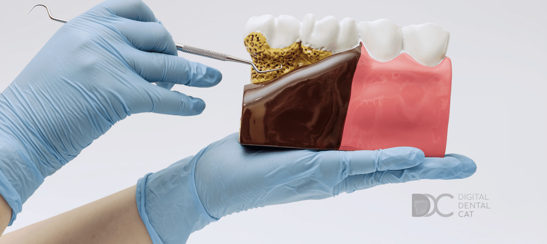 periodontitis