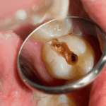 caries del biberón