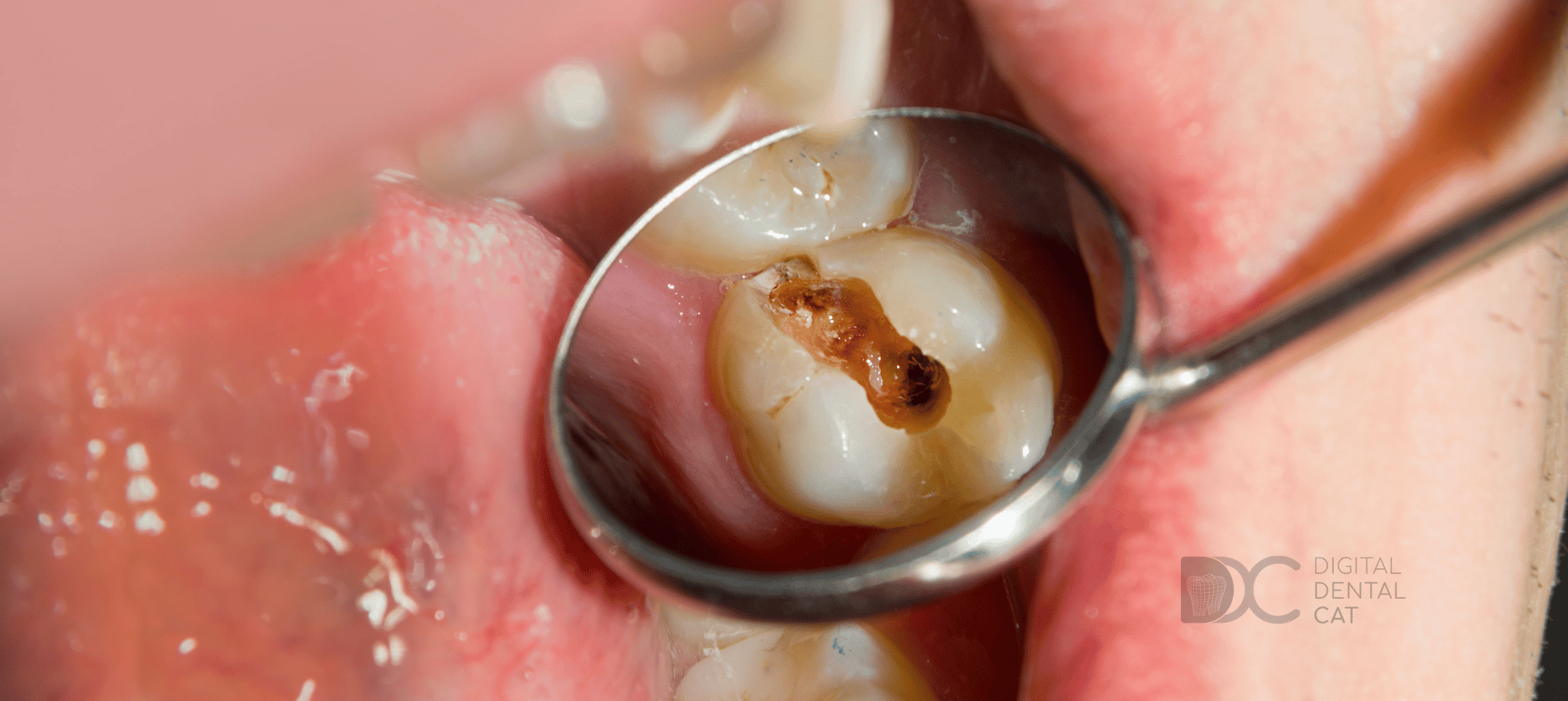 caries del biberón