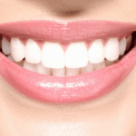 tratamiento sonrisa gingival