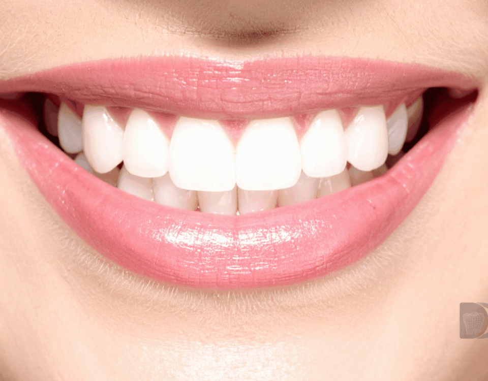 tratamiento sonrisa gingival