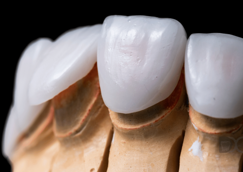 Carillas de porcelana